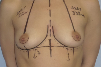 Avant augmentation mammaire Patiente 2