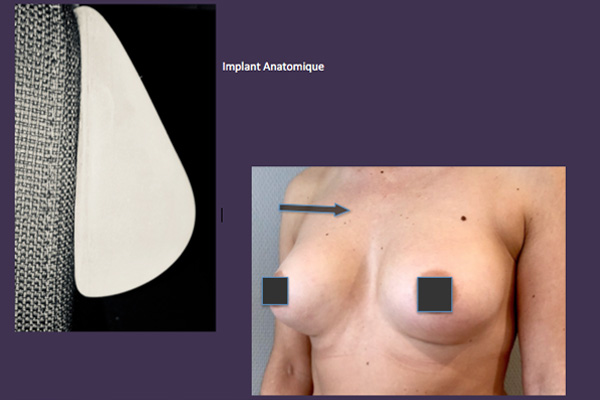 Implant Anatomique