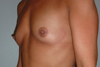Avant augmentation mammaire Patiente 1