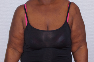 Avant lifting bras